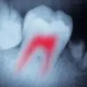 root canal